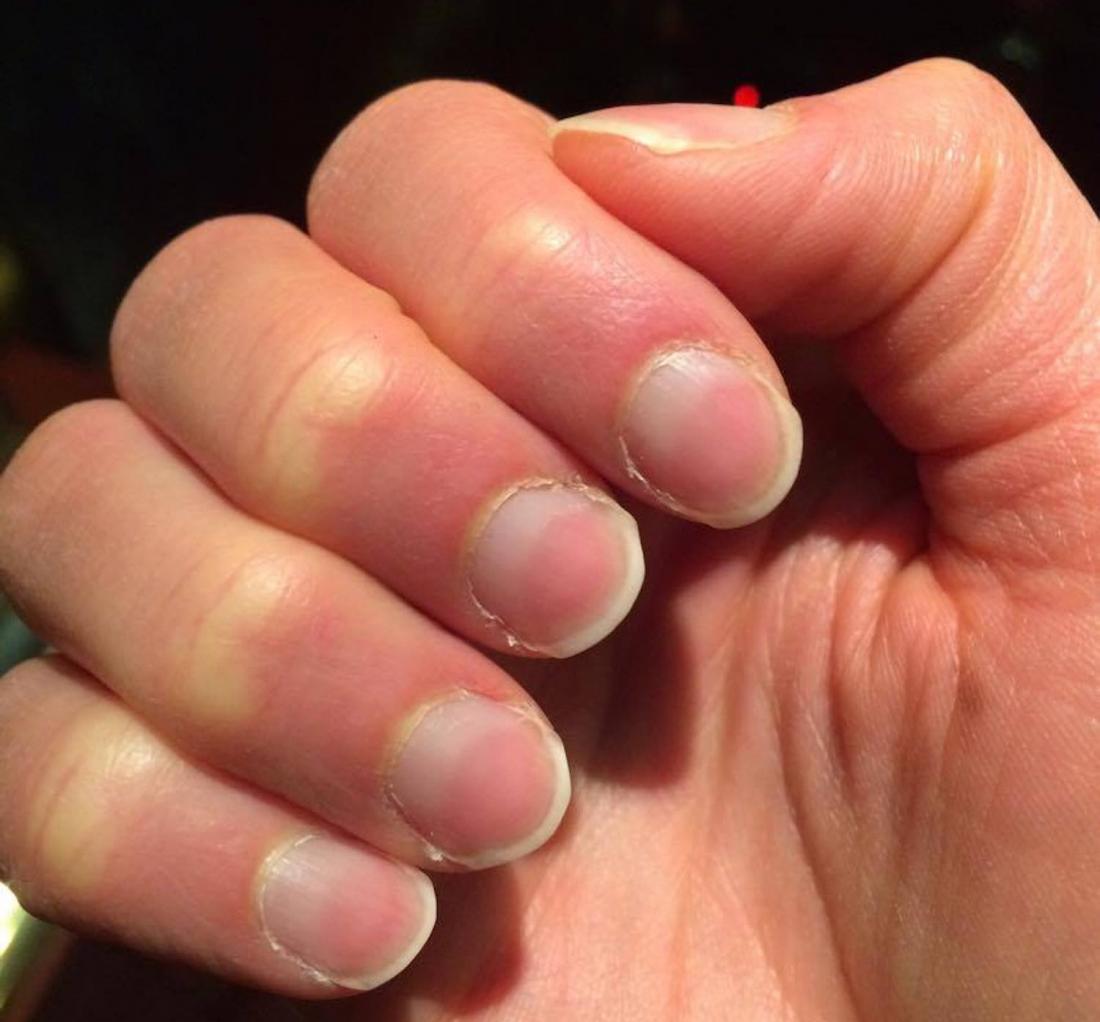 What Causes Red Under Fingernails