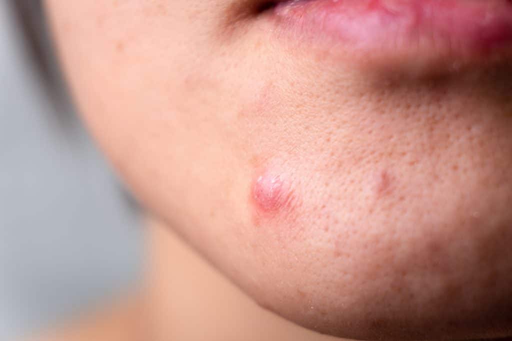 Causes Of Acne And Ways To Get Rid Of It | Healthy Foods Mag